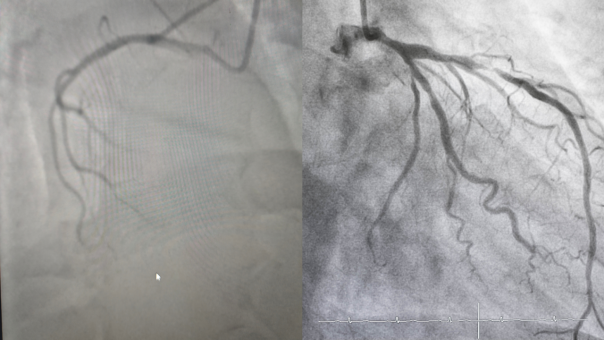 （挂网稿）别让“隐形危机”夺走健康！冠脉 CTA+AI筛查，揪出冠心病早期隐患888.png